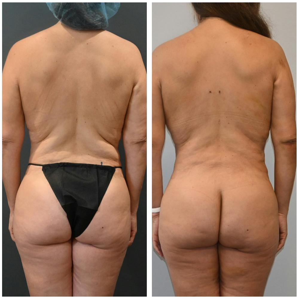 Brazilian Butt Lift Before & After Gallery - Patient 366064 - Image 1
