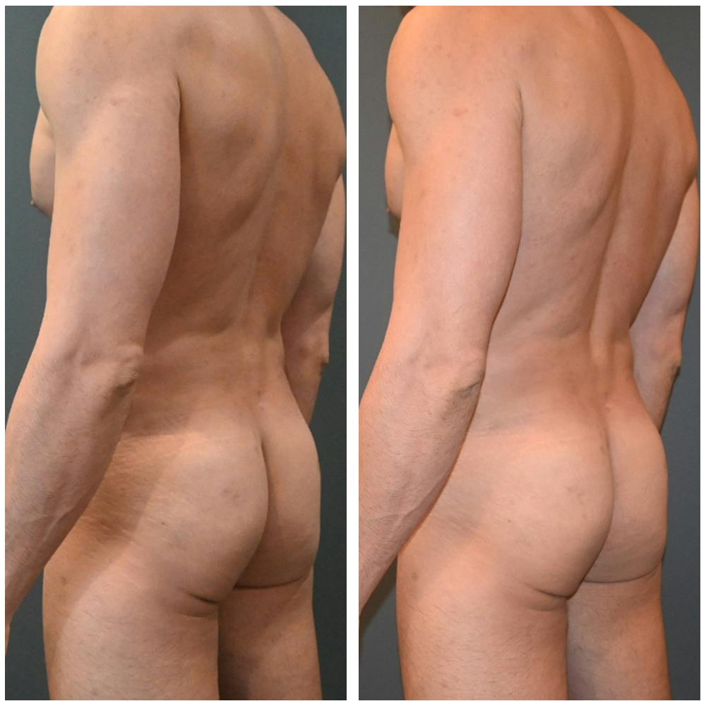 Lux Lipo Before & After Gallery - Patient 396646 - Image 3