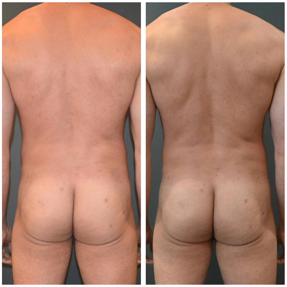 Lux Lipo Before & After Gallery - Patient 396646 - Image 4