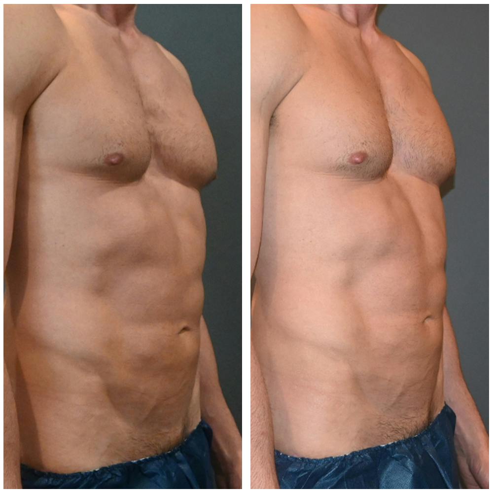 Lux Lipo Before & After Gallery - Patient 396646 - Image 7