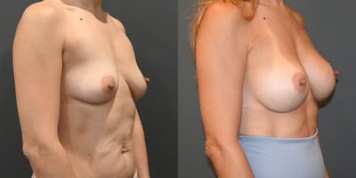 Breast Augmentation  Before & After Photos - Patient 193962 - Image 2