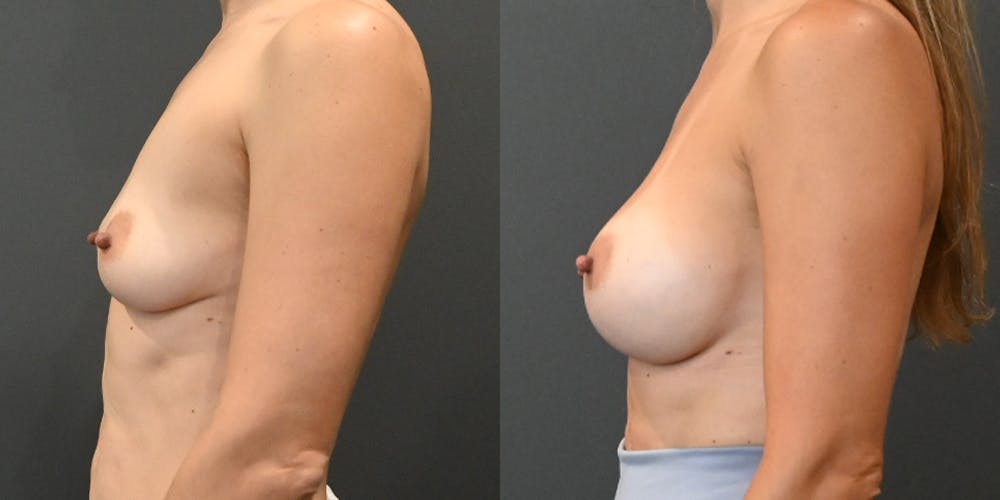 Breast Augmentation  Before & After Gallery - Patient 193962 - Image 3