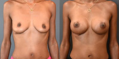 Breast Augmentation  Before & After Photos - Patient 187537 - Image 1