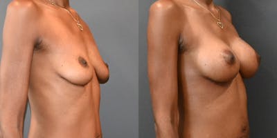 Breast Augmentation  Before & After Gallery - Patient 187537 - Image 2