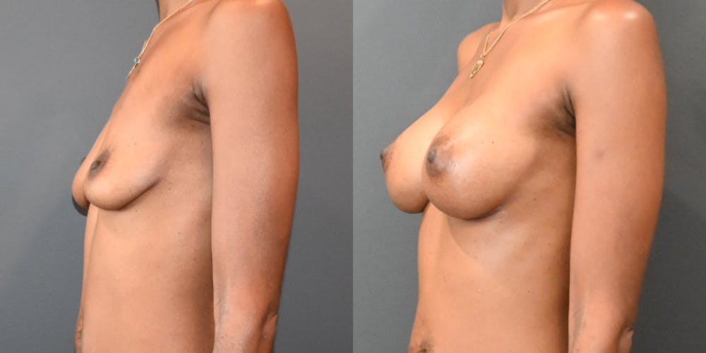 Breast Augmentation  Before & After Photos - Patient 187537 - Image 3