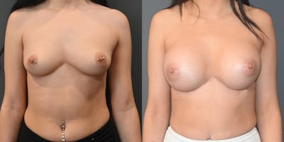 Breast Augmentation  Before & After Photos - Patient 220097 - Image 1