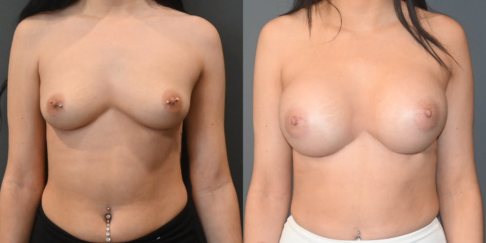 Breast Augmentation  Before & After Gallery - Patient 220097 - Image 1