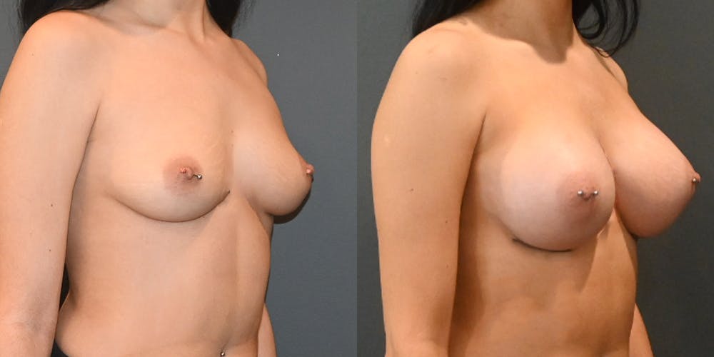 Breast Augmentation  Before & After Photos - Patient 220097 - Image 2