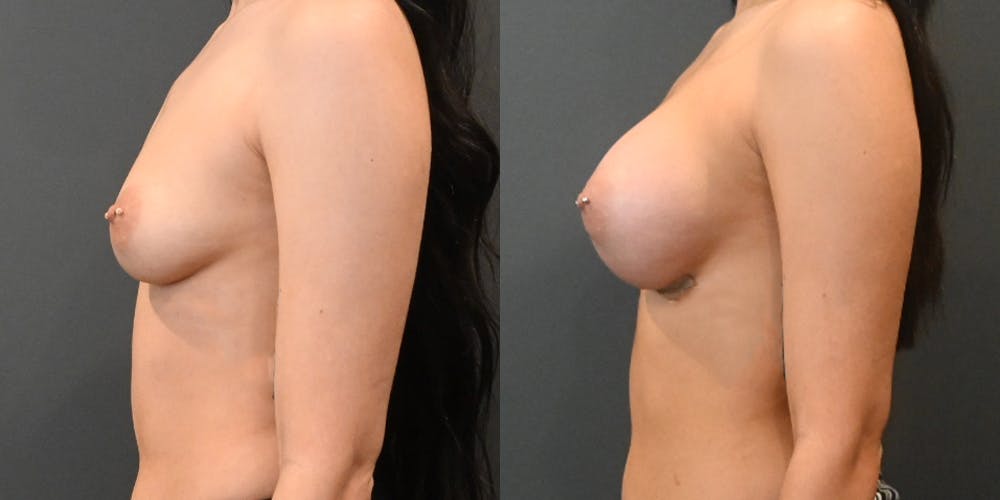 Breast Augmentation  Before & After Gallery - Patient 220097 - Image 3