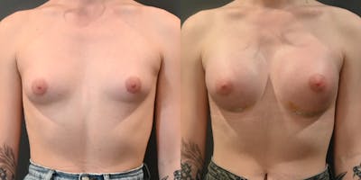 Transgender Breast Augmentation Before & After Photos - Patient 327132 - Image 1