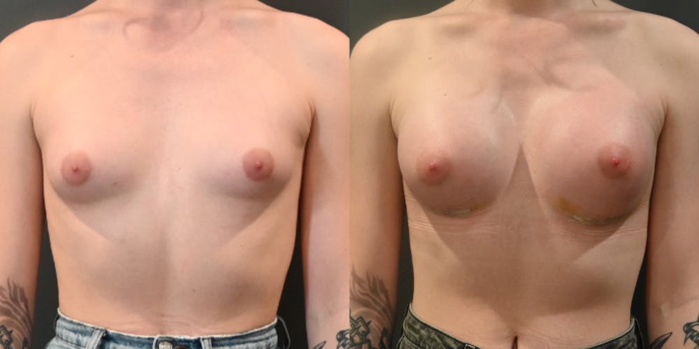 Transgender Breast Augmentation Before & After Gallery - Patient 327132 - Image 1