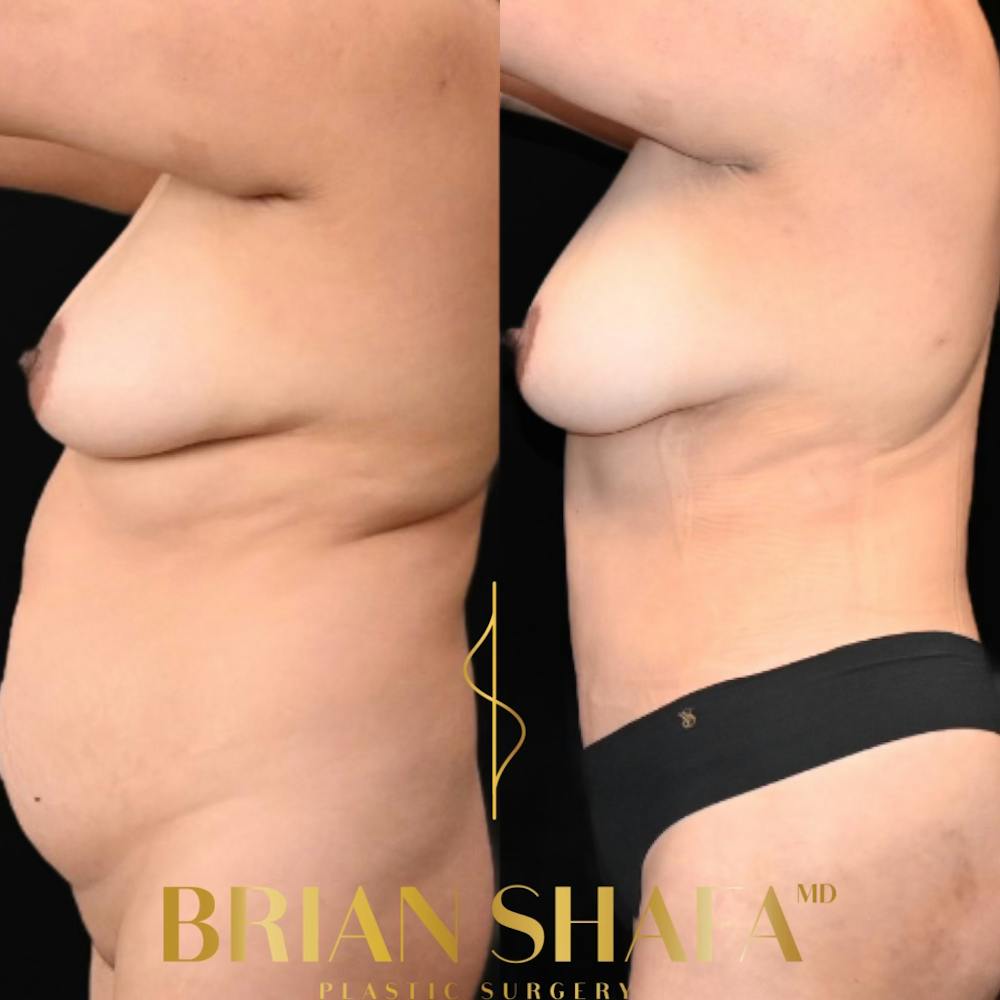 HD Tummy Tuck Before & After Photos - Patient 196299 - Image 3