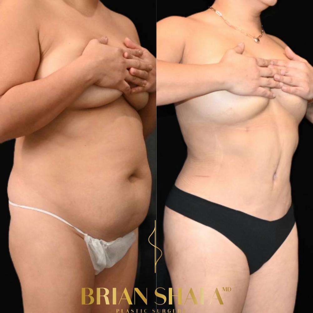 HD Tummy Tuck Before & After Photos - Patient 196299 - Image 1
