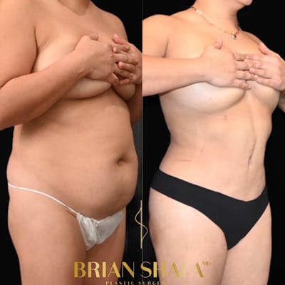 HD Tummy Tuck Before & After Gallery - Patient 196299 - Image 1