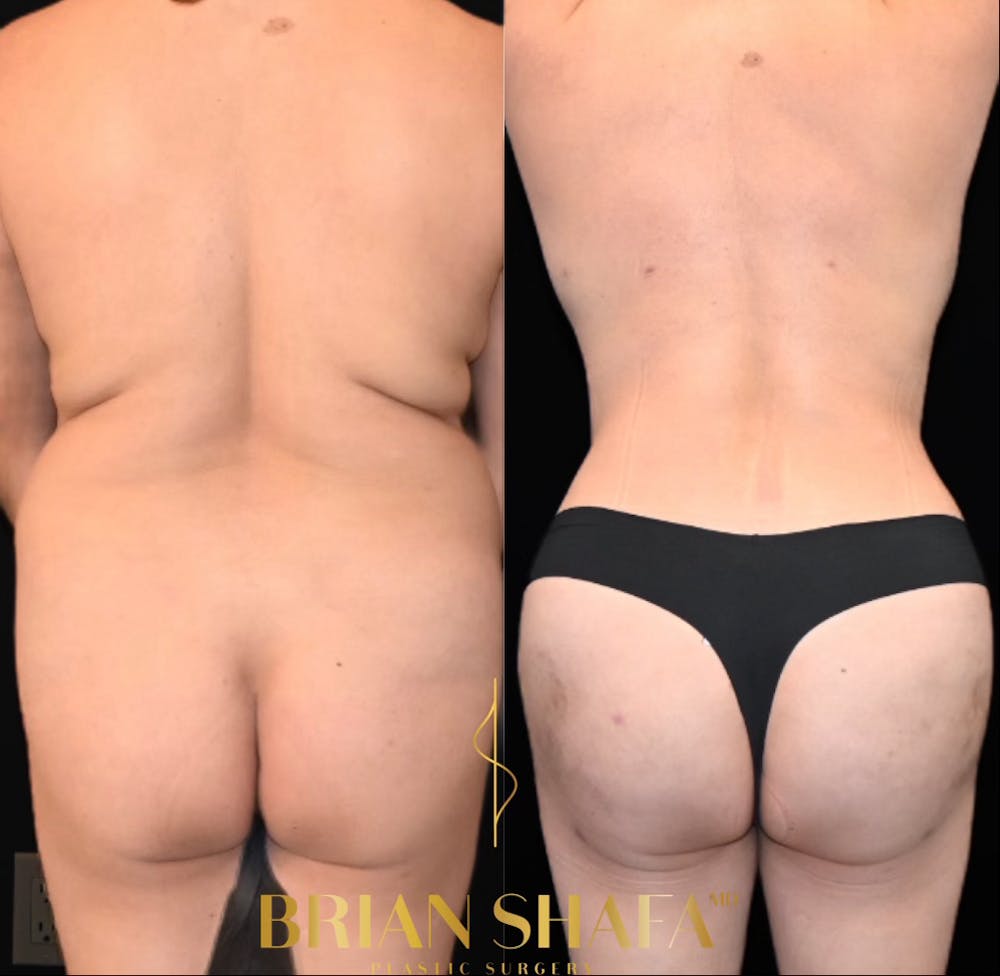 HD Tummy Tuck Before & After Photos - Patient 196299 - Image 4
