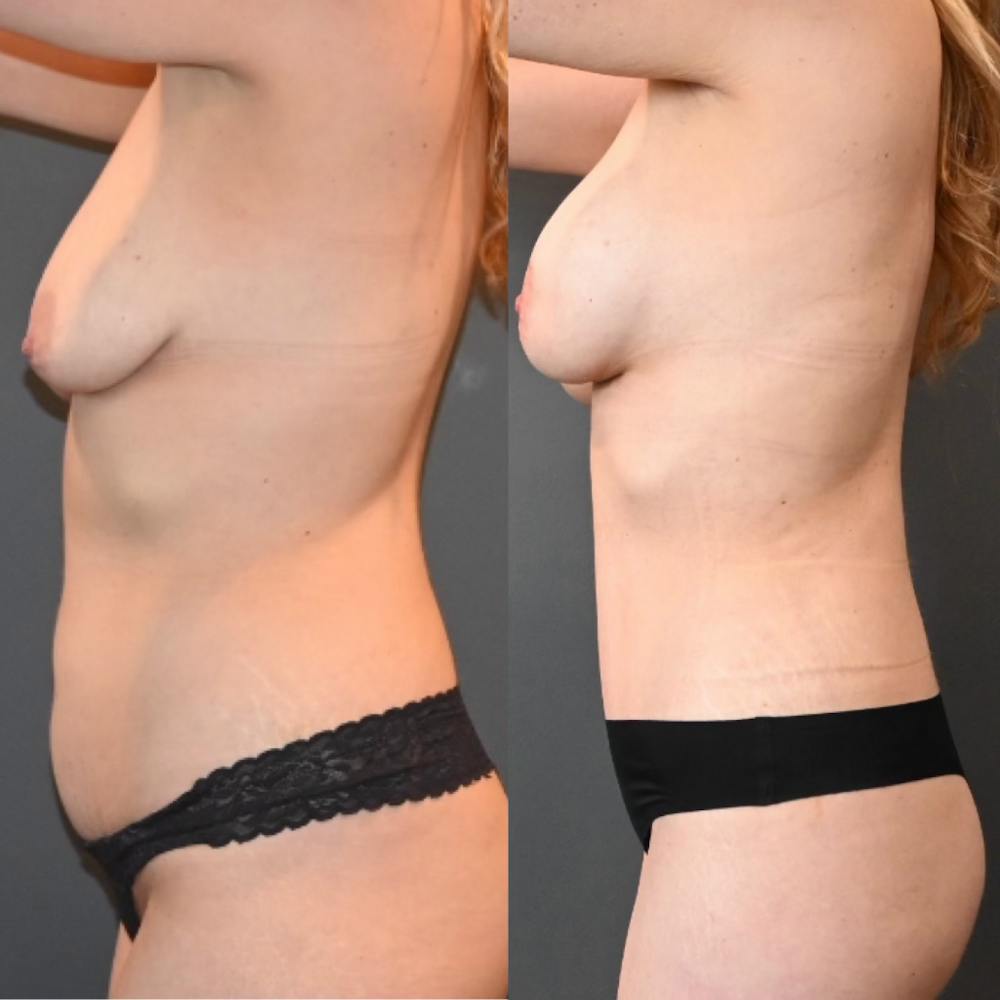 Lux Tuck Before & After Gallery - Patient 169228 - Image 2