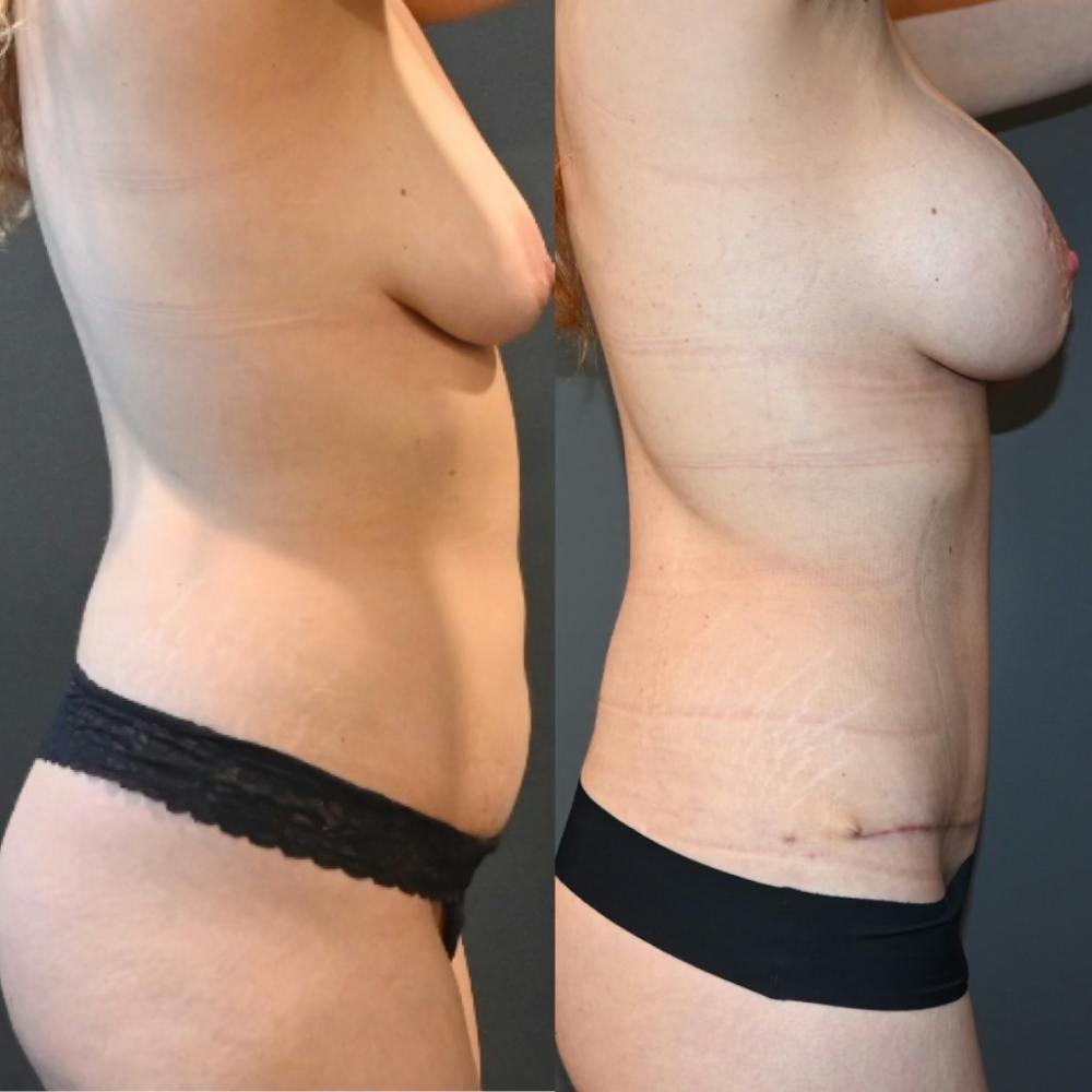 Lux Tuck Before & After Photos - Patient 169228 - Image 3