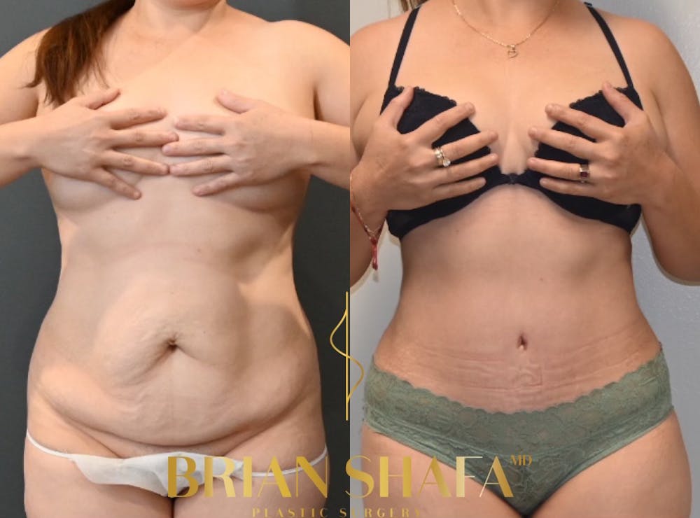 HD Tummy Tuck Before & After Photos - Patient 229053 - Image 2