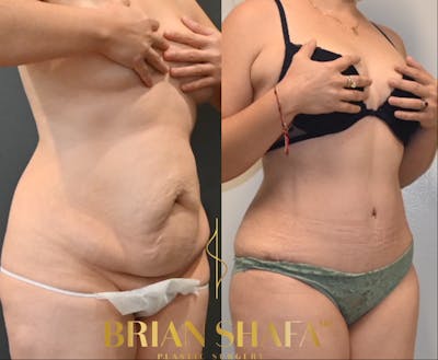 HD Tummy Tuck Before & After Photos - Patient 229053 - Image 1