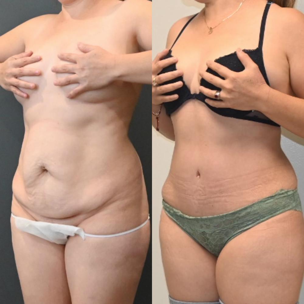 HD Tummy Tuck Before & After Gallery - Patient 229053 - Image 3