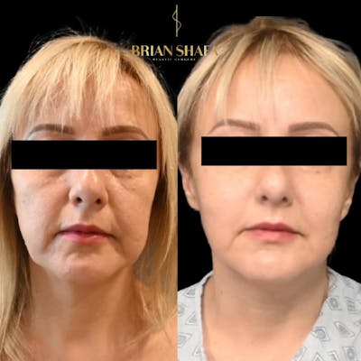 Facial Fat Grafting Before & After Gallery - Patient 189225 - Image 1