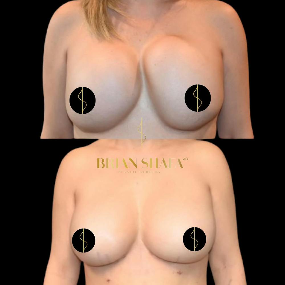 Breast Revision Before & After Photos - Patient 134925 - Image 1