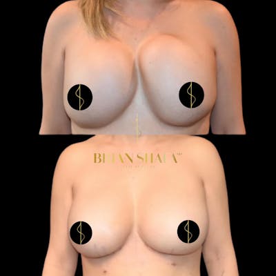 Breast Revision Before & After Gallery - Patient 134925 - Image 1