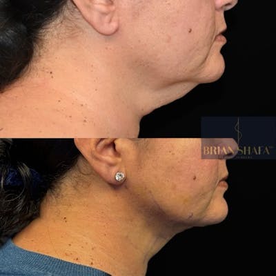 Facelift/Necklift Before & After Photos - Patient 280159 - Image 1