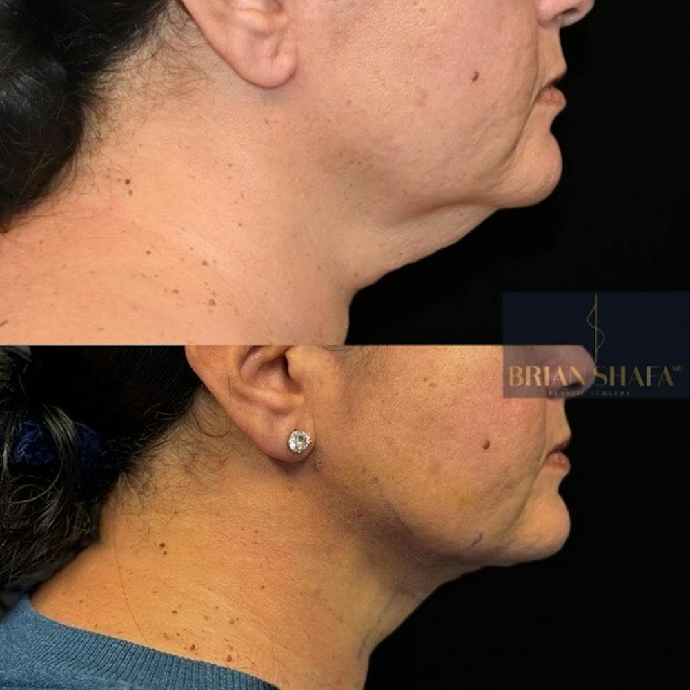 Facelift/Necklift Before & After Photos - Patient 280159 - Image 1