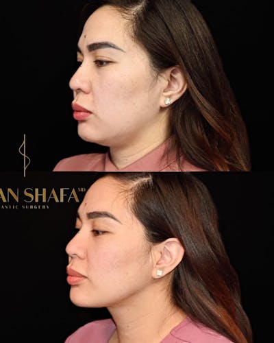 Jawline Contouring  Before & After Photos - Patient 314591 - Image 1