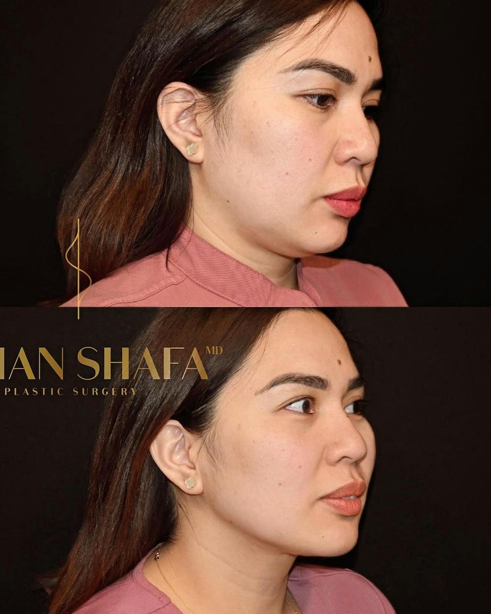 Jawline Contouring  Before & After Gallery - Patient 314591 - Image 2