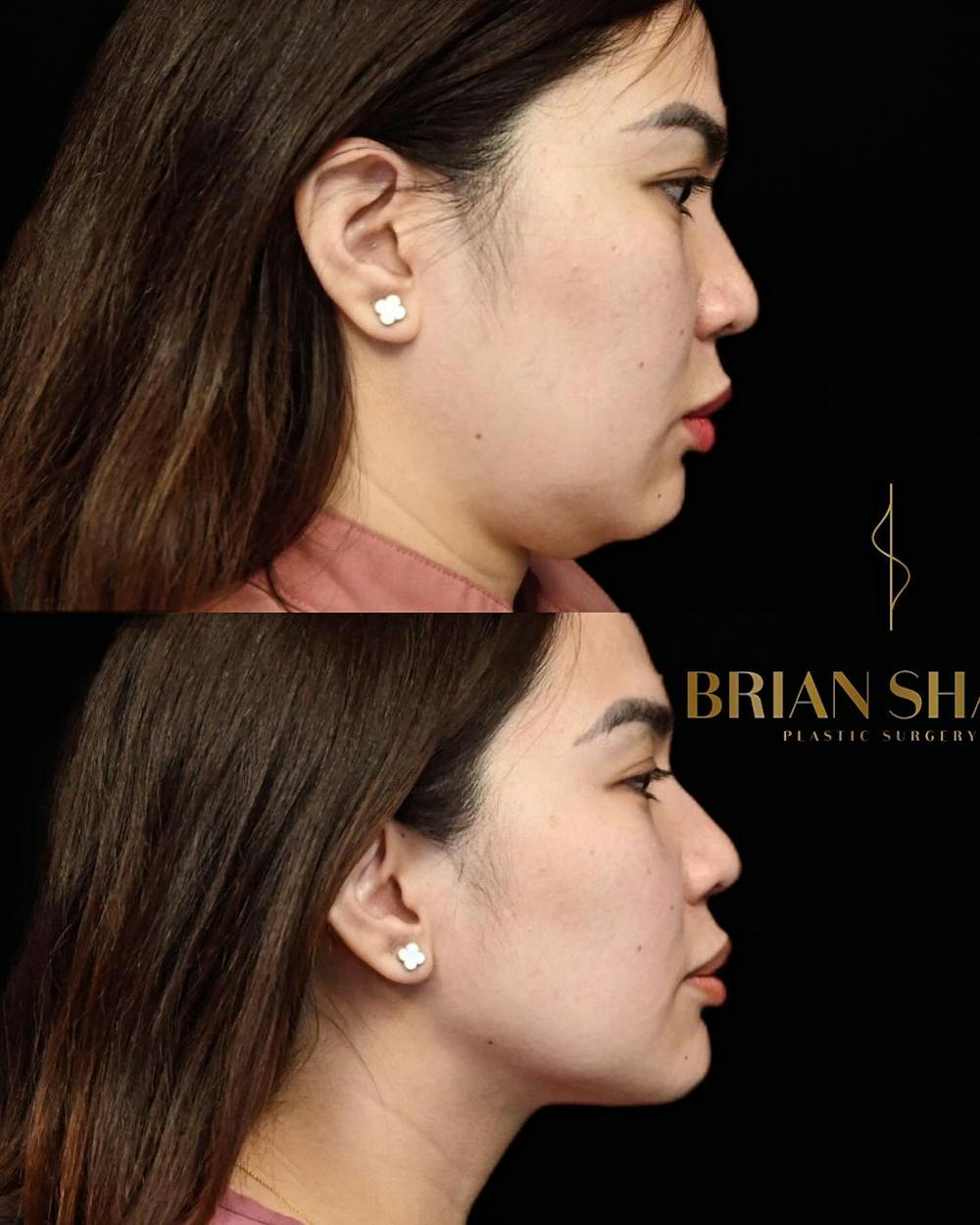 Jawline Contouring  Before & After Gallery - Patient 314591 - Image 3