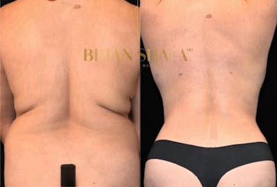 Lux Tuck Before & After Photos - Patient 264452 - Image 1