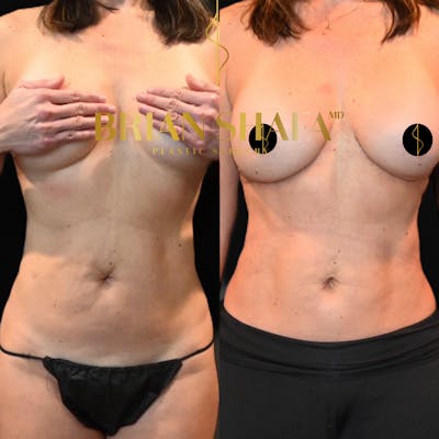 Reverse Tummy Tuck Before & After Photos - Patient 132052 - Image 1