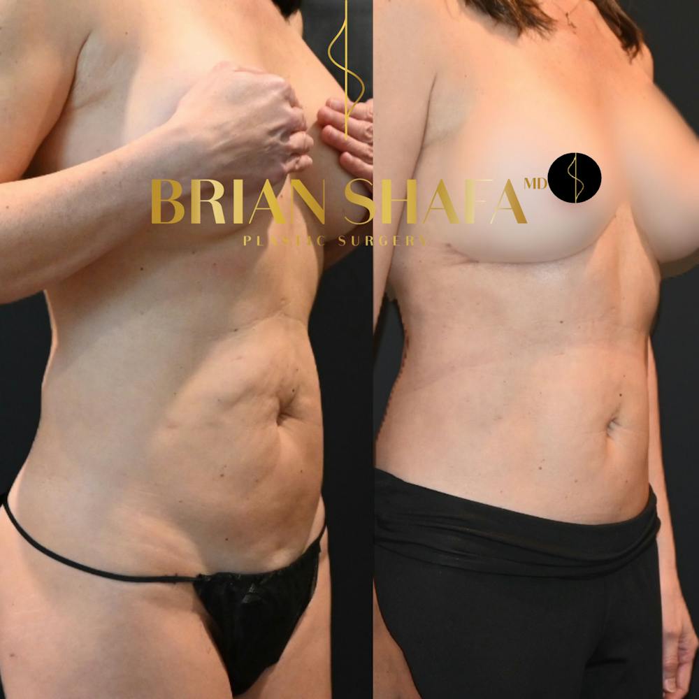 Reverse Tummy Tuck Before & After Photos - Patient 132052 - Image 2