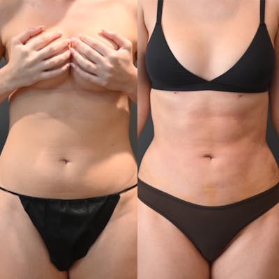 Lux Lipo Before & After Photos - Patient 127418 - Image 1