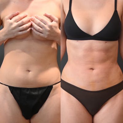 Lux Lipo Before & After Photos - Patient 127418 - Image 1