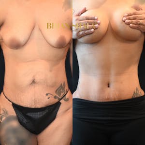 Mommy makeover procedure before and after