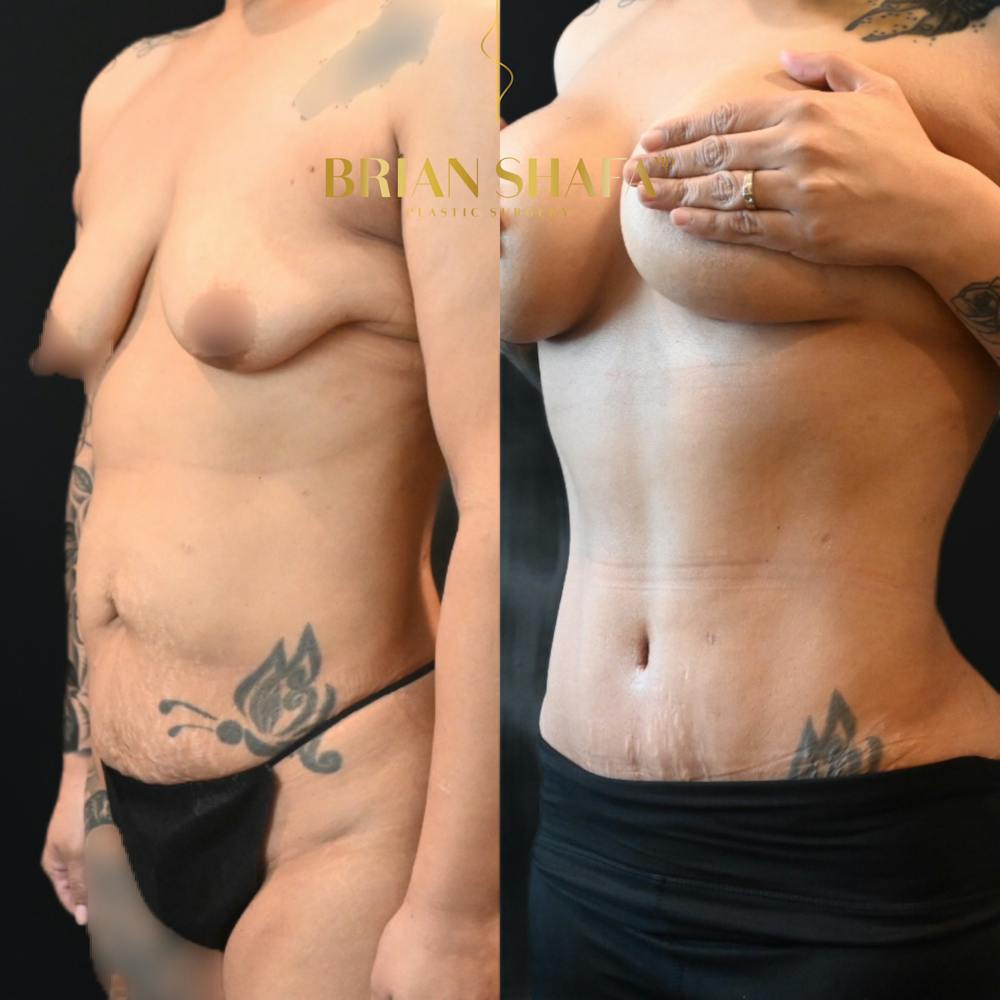 Tummy Tuck (Abdominoplasty) Before & After Photos - Patient 100113 - Image 2