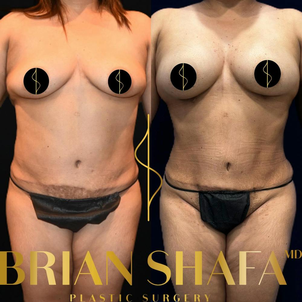 Lux Lipo Before & After Photos - Patient 413943 - Image 1