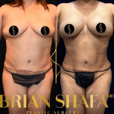 Lux Lipo Before & After Photos - Patient 413943 - Image 1