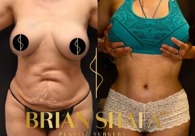 Tummy Tuck (Abdominoplasty) Before & After Photos - Patient 180452 - Image 1