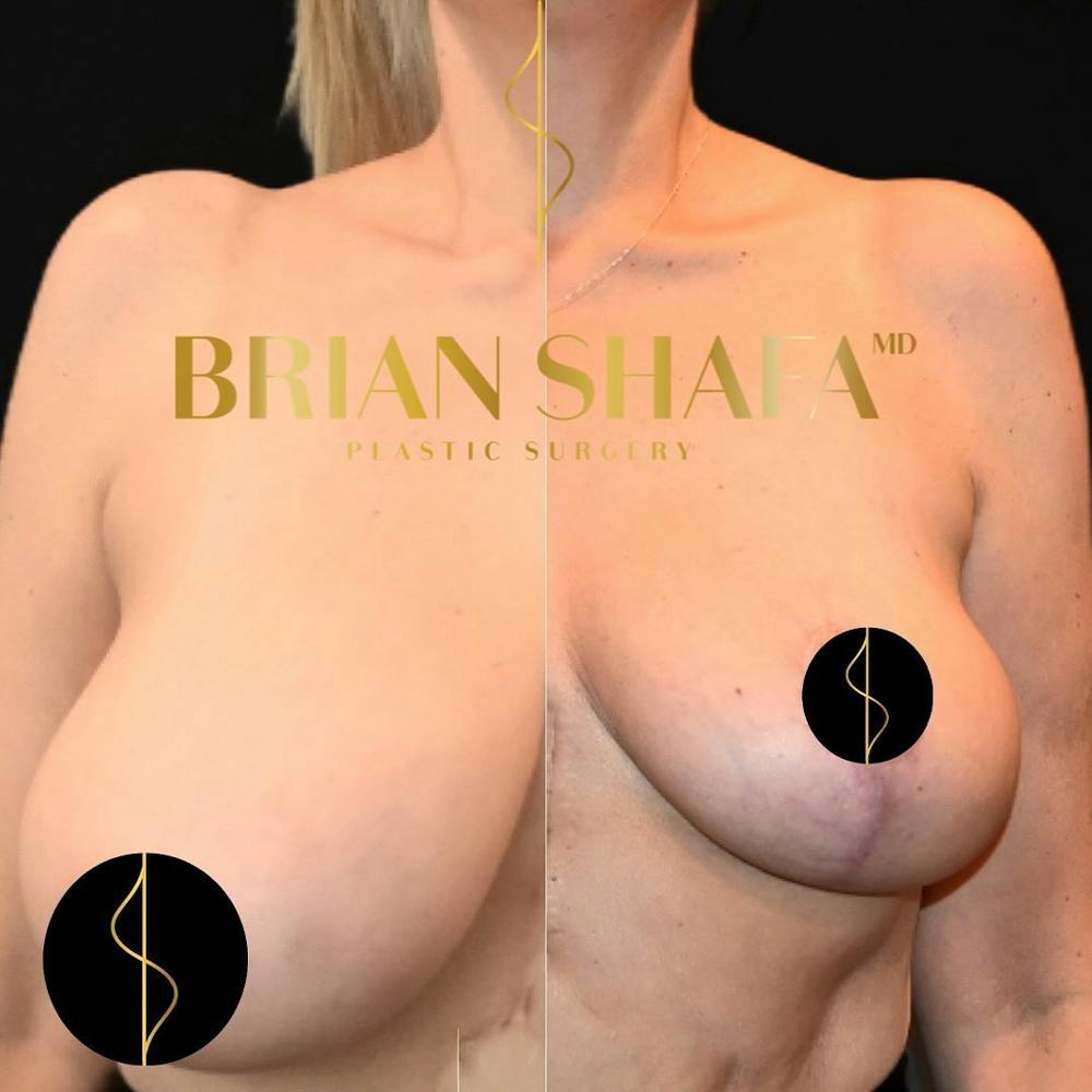 Breast Reduction in Beverly Hills Before and After Photos