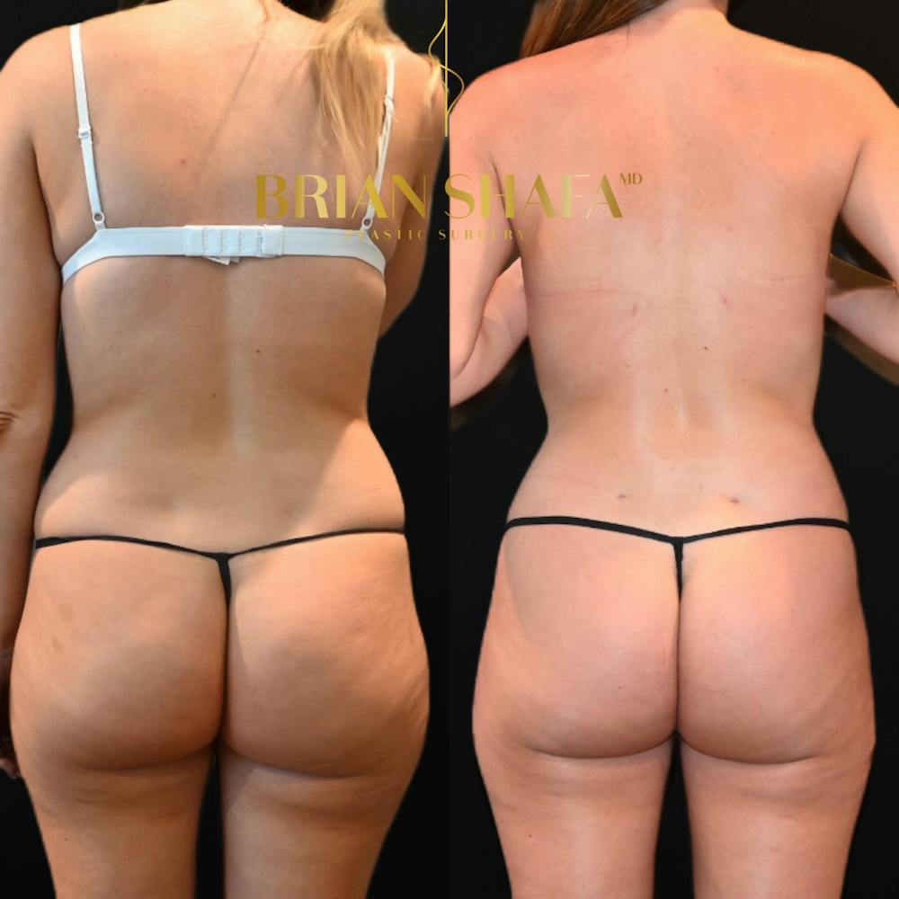 Lux Lipo Before & After Photos - Patient 392212 - Image 1