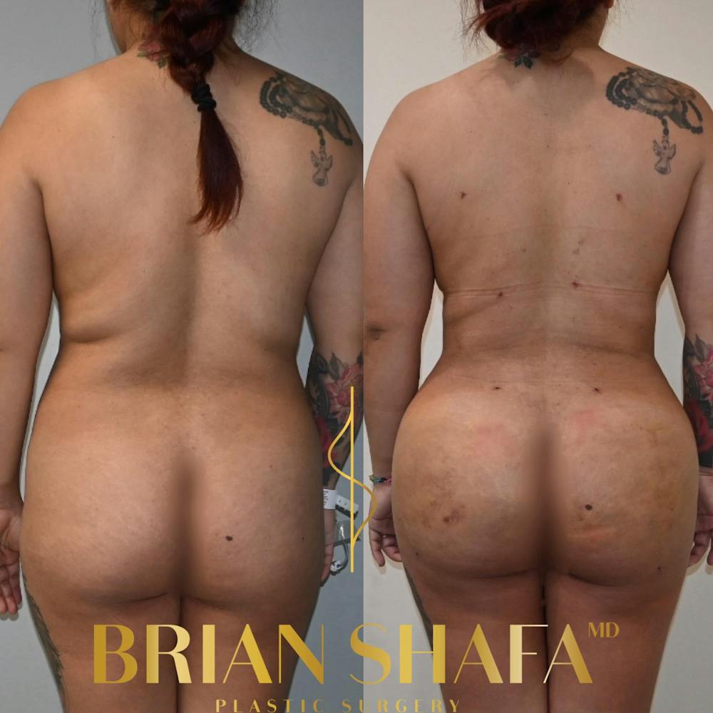 Brazilian Butt Lift Before & After Photos - Patient 252882 - Image 1