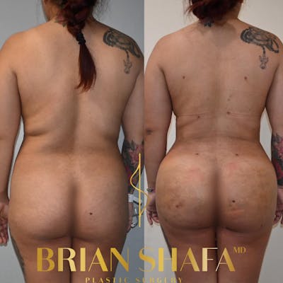 Brazilian Butt Lift Before & After Photos - Patient 252882 - Image 1