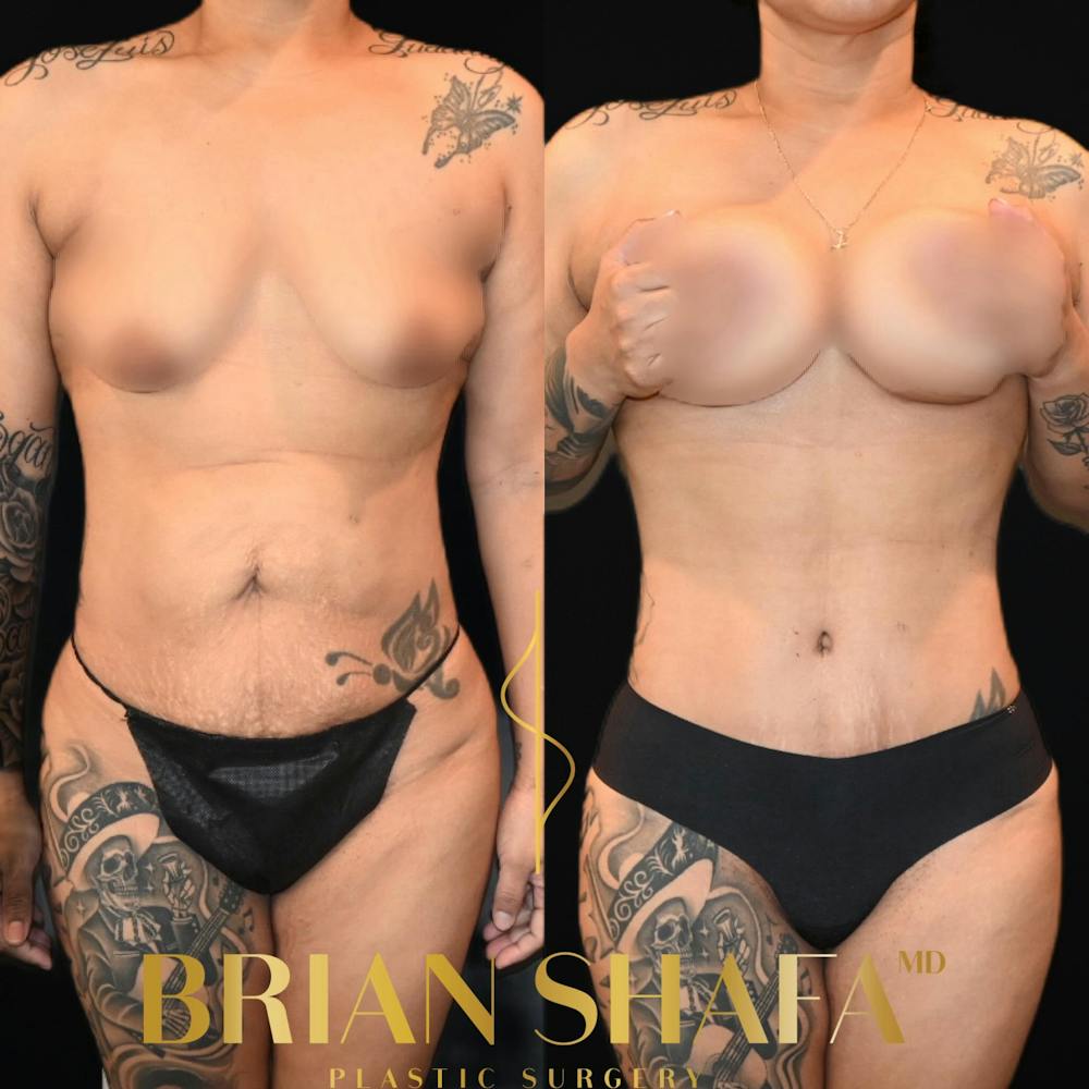 Mommy Makeover Before & After Photos - Patient 389079 - Image 1