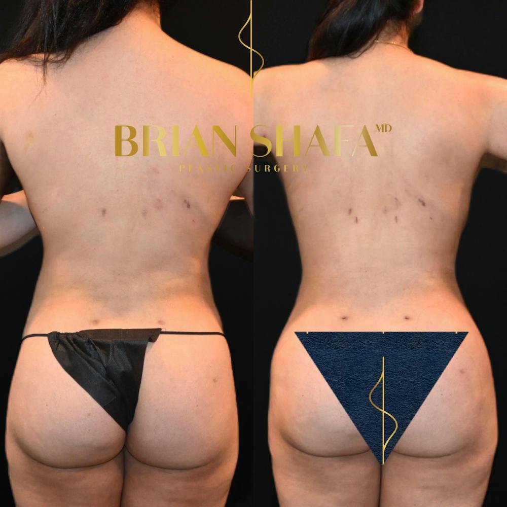 Lux Lipo Before & After Photos - Patient 331451 - Image 1