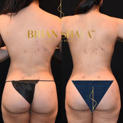 Lux Lipo Before & After Photos - Patient 331451 - Image 1