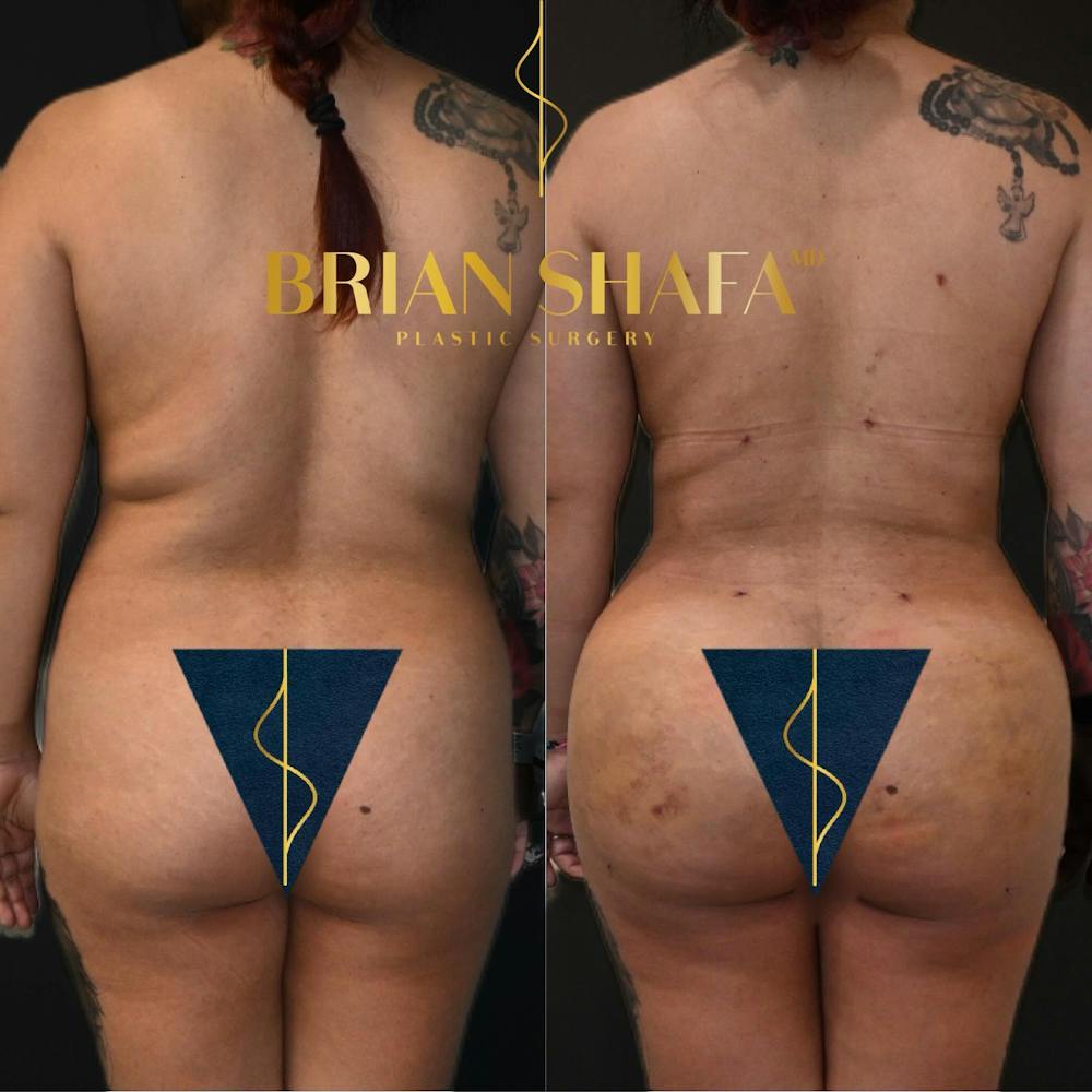 Brazilian Butt Lift Before & After Photos - Patient 398560 - Image 1